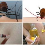 Как вытащить клеща в домашних условиях